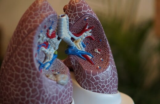 Καρκίνος του πνεύμονα: Ο προσυμπτωματικός έλεγχος βελτιώνει τη μακροπρόθεσμη επιβίωση των ασθενών