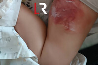 Θαλάσσια ανεμώνη: Με έγκαυμα 4χρονη από τσίμπημα σε παραλία της Φθιώτιδας