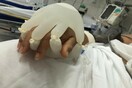 «Χέρια αγάπης»: Πλαστικά γάντια με ζεστό νερό «βοηθούν» ασθενείς με κορωνοϊό