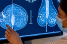 Τεράστιο άλμα στο ποσοστό επιβίωσης από τον καρκίνο του μαστού- και οι λόγοι είναι τρεις