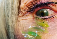 Γιατρός αφαίρεσε 23 φακούς επαφής από το μάτι ασθενούς