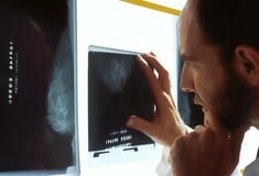 Καρκίνος του προστάτη: Η Αγγλία θέλει να επιταχύνει τη διάγνωση μέσω της τεχνητής νοημοσύνης