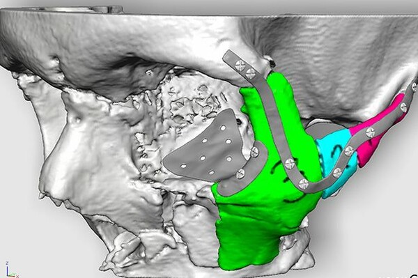 Η πρώτη ανάπλαση προσώπου με μοσχεύματα από 3D εκτυπωτή
