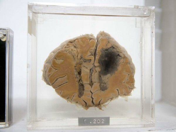 23χρονος Αμερικανός πούλησε ανθρώπινους εγκεφάλους στο ebay