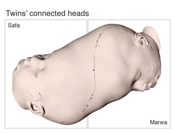 Διαχώρισαν σιαμαία δίδυμα κορίτσια, ενωμένα στο κεφάλι - Βοήθησαν 100 γιατροί