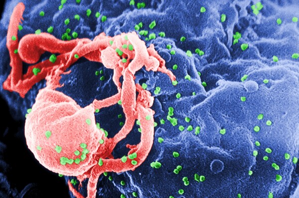 Νέα έρευνα παρέχει βάσιμες ελπίδες για την οριστική θεραπεία του AIDS