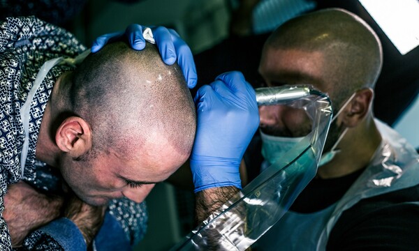 Scalp micropigmentation: Γιατί πολλοί φαλακροί άντρες αποφάσισαν να το δοκιμάσουν