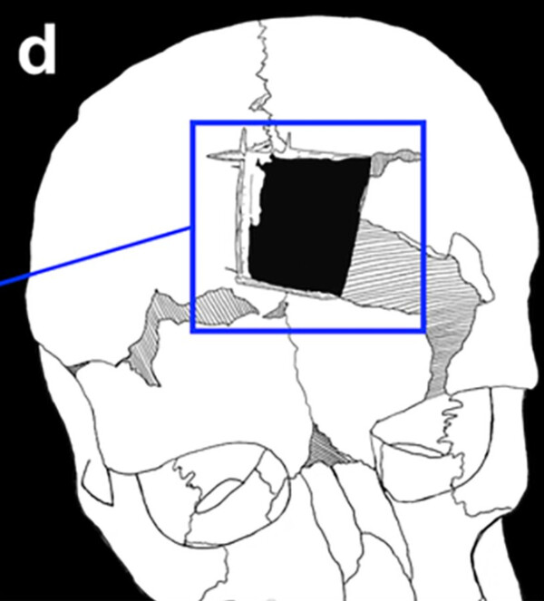 Ισραήλ: Ο άνθρωπος με μια τετράγωνη τρύπα στο κρανίο του -Ένδειξη για χειρουργική εγκεφάλου πριν 3.500 χρόνια