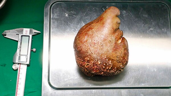 World’s largest kidney stone removed – and it’s the size of a grapefruit