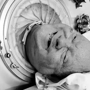 Πέθανε ο άνθρωπος που έζησε 72 χρόνια σε «σιδερένιο πνεύμονα» μετά από πολιομυελίτιδα