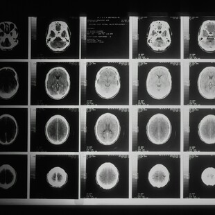 Καναδάς: Ενδείξεις για νέα μυστηριώδη νευρολογική ασθένεια - Επιστήμονες καταγγέλουν απαγόρευση μελέτης 